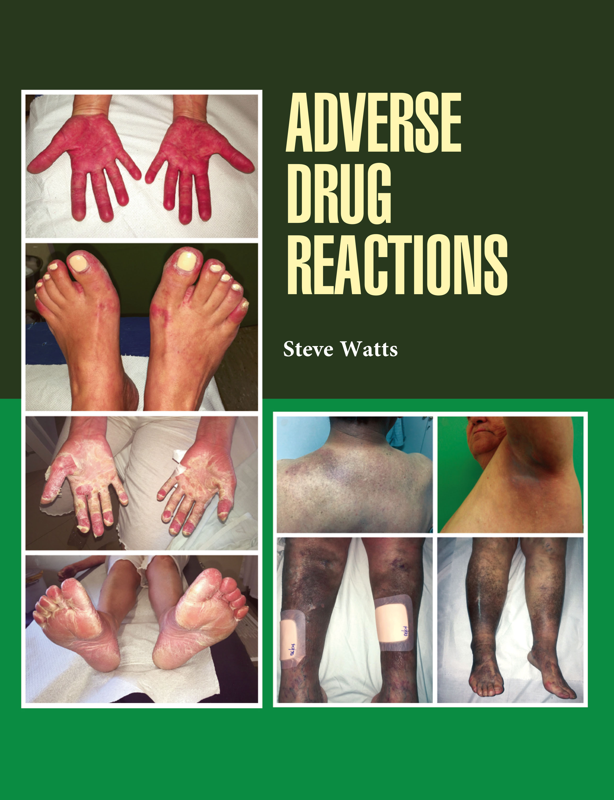 Adverse Drug Reactions