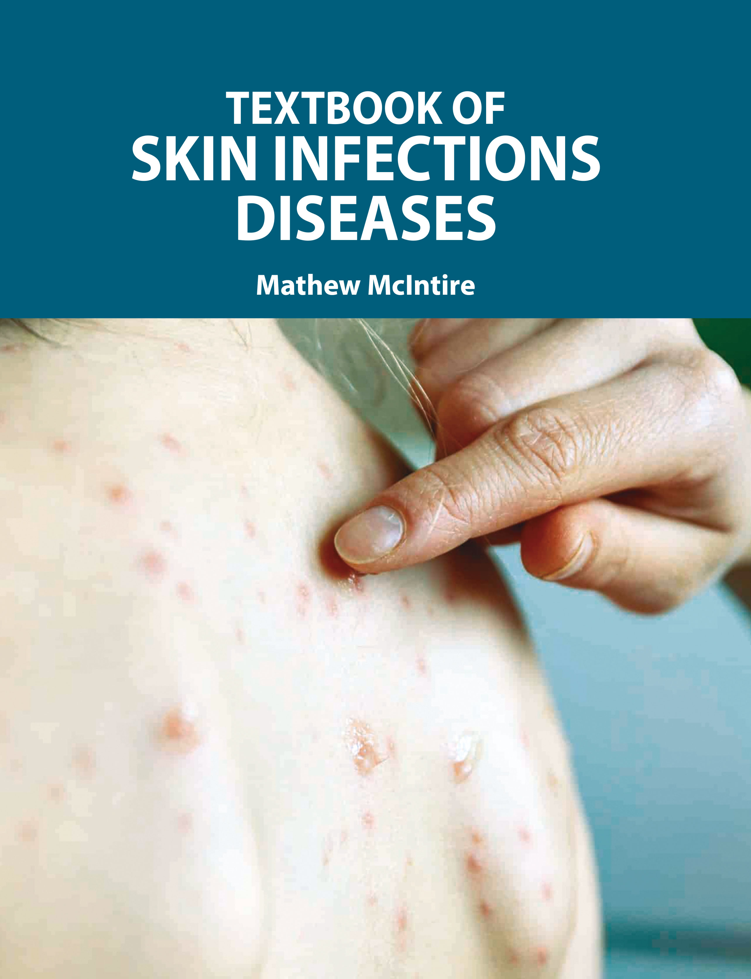 Textbook of Skin Infections Diseases